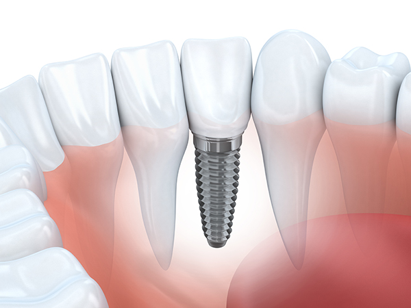 Kailua Dental Implant Restoration